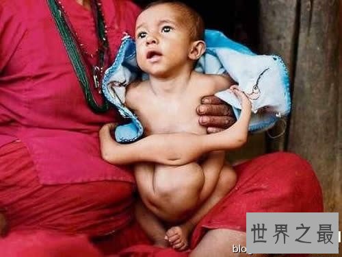 世界上腿最多的女人,四腿女子如何过性生活