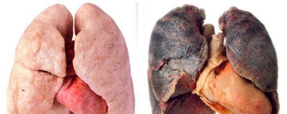 戒烟相当于整容? 1张图片说明一切!