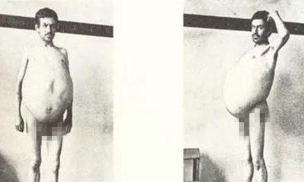 史上第一个被“屎”憋死的人，三年没上厕所