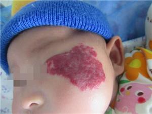 血管瘤有哪些症状表现?几张图来告诉你