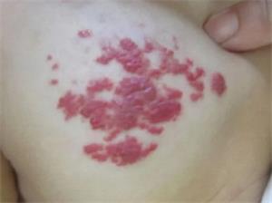 血管瘤有哪些症状表现?几张图来告诉你