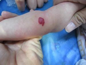 血管瘤有哪些症状表现?几张图来告诉你