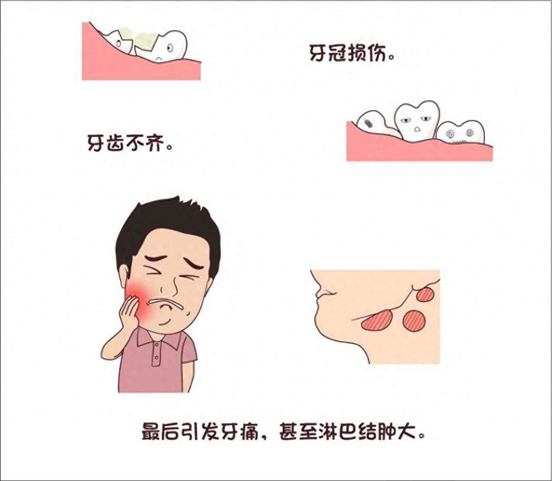 口腔常识手册之智齿,一组图带你了解智齿为什么疼