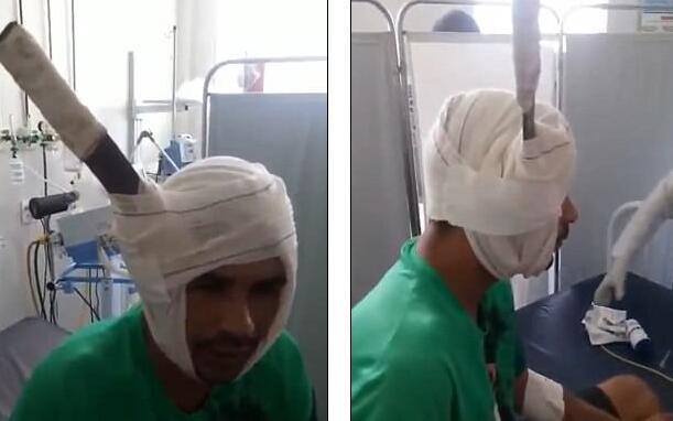 男子头部被插入一把刀，经过5个小时的手术成功取出，捡回一条命