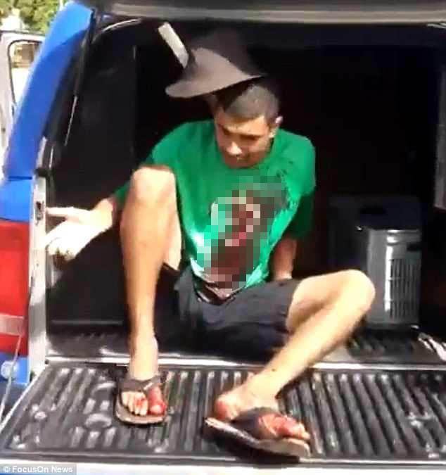 男子头部被插入一把刀，经过5个小时的手术成功取出，捡回一条命